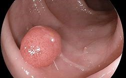 Pólipo e Câncer Colorretal