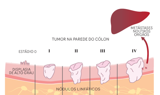 Pólipo e Câncer Colorretal