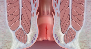 Fissura anal Diagnóstico e tratamento