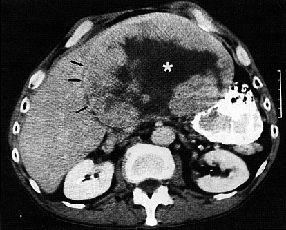 Metastases e tumores primários