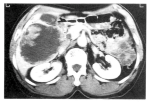 Metastases e tumores primários
