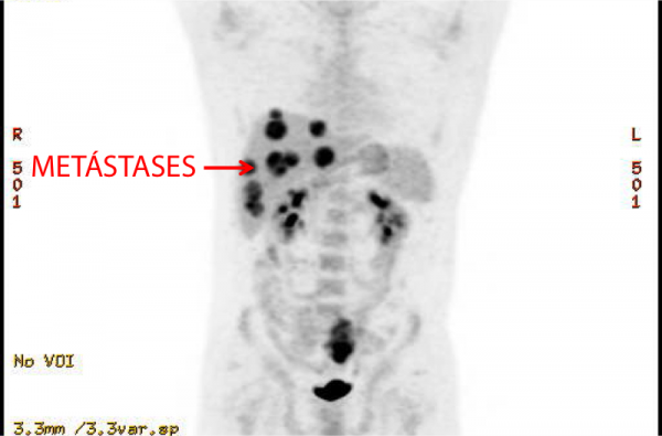 Metastases e tumores primários